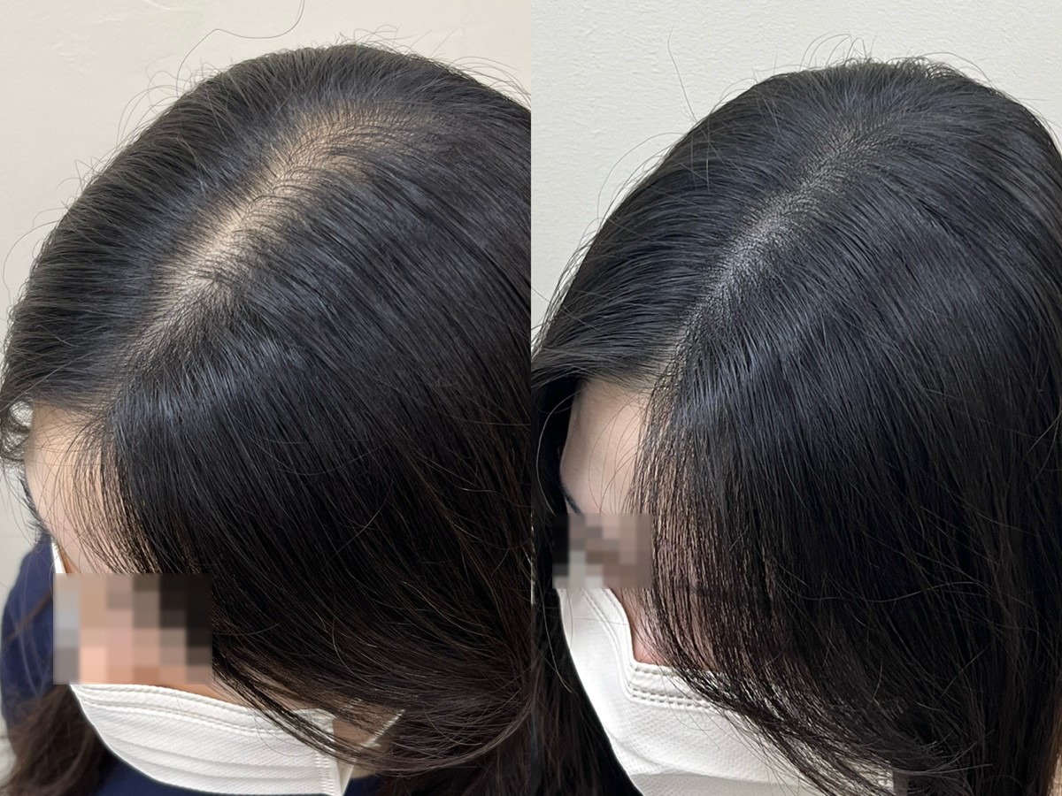 여성 가르마 두피문신 비포애프터