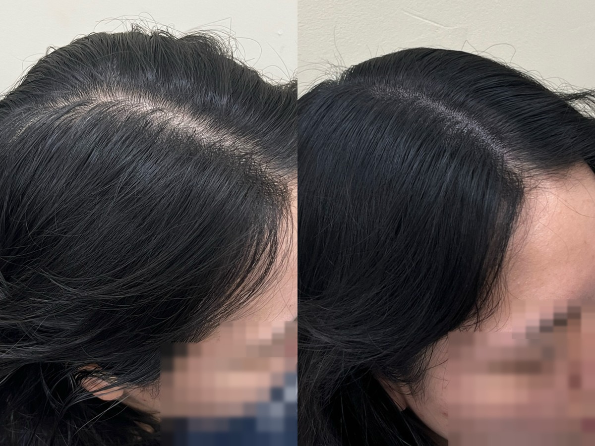 여성 가르마 두피문신 비포애프터