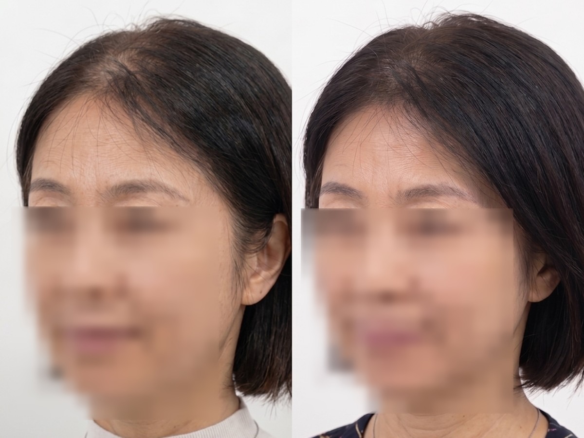 여성 가르마 두피문신 비포애프터